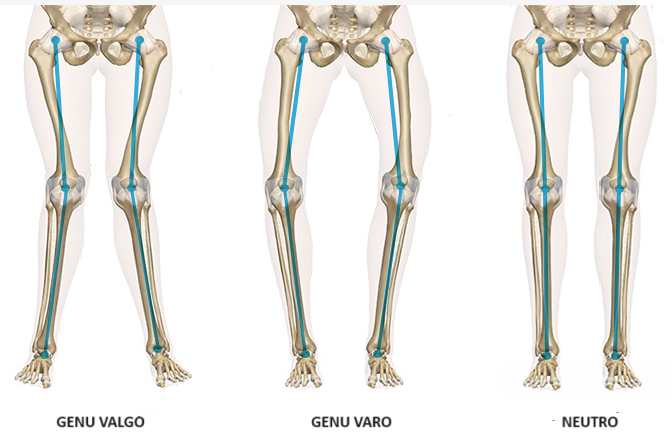 Técnicas Personalizadas en Prótesis de Rodilla mediante la Alineación ...